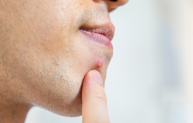 ニキビで悩む男性　皮膚科に行くべきか　恥ずかしい　悩んでいる